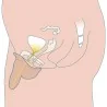 Stand to Pee packer 3 - non circoncis